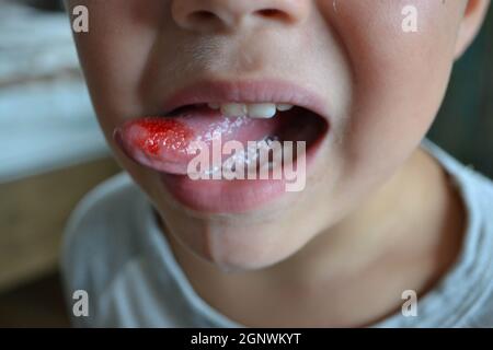 Nahaufnahme von Lippen, Zunge, Blutvorsprüngen. Gebissene Zunge des Kindes. Stockfoto