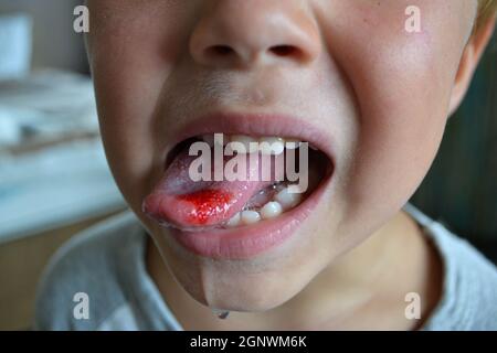 Nahaufnahme von Lippen, Zunge, Blutvorsprüngen. Gebissene Zunge des Kindes. Stockfoto