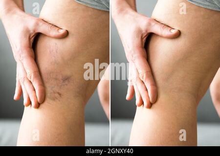 Vor Nach Cellulite Entzündung Beine Behandlung Closeup Stockfoto