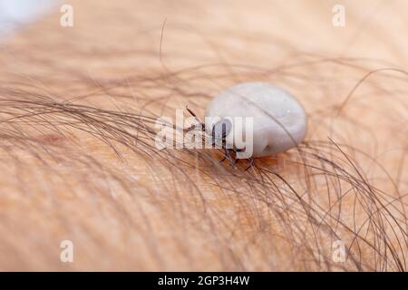 Zecken (Ixodes ricinus) auf der Haut des Menschen, die mit Blut gefüllt ist. Gefahr Insekt kann sowohl bakterielle als auch virale Krankheitserreger wie die Erreger von L übertragen Stockfoto