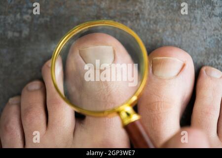 Eingewachsene Nail Problem. Infizierte Rote Füße Zehennagel Stockfoto