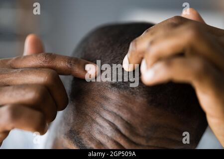 Junge Afrikanische Männer Haarausfall. Haarausfall Beobachten Stockfoto