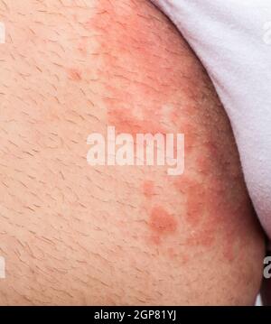 Ekzem Leistengegend atopischer Dermatitis Symptom der Hautstruktur Stockfoto
