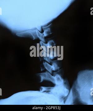 Scan der Röntgenaufnahme des Halses, zervikalen Bereich Stockfoto
