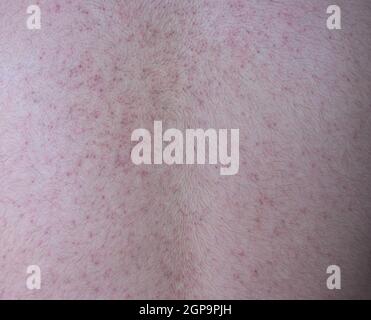 Hintergrund der menschlichen Haut mit allergischen roten Flecken. Ekzem atopische Dermatitis Symptom Haut auf dem Rücken des Menschen. Stockfoto