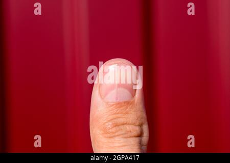 Gespaltener Nagel am Daumen. Dilatation des Nagels, traumatische Pathologie. Der Nagel ist in zwei Hälften unterteilt. Stockfoto