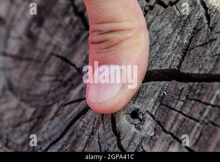 Gespaltener Nagel am Daumen. Dilatation des Nagels, traumatische Pathologie. Der Nagel ist in zwei Hälften unterteilt. Stockfoto