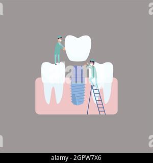 Zwei Zahnärzte führen eine Zahnimplantation durch und installieren das Implantat auf dem Abutment. Vektorgrafik, in einem flachen Stil. Poster zur Klinik, Bild für Zahnarztanweisungen, Schulungsbücher Stock Vektor