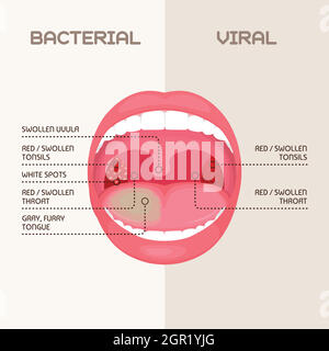 Kehle bakterielle und virale Infektion, Mandeln Entzündung. Stock Vektor