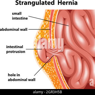 Strangulierter Hernie Stock Vektor