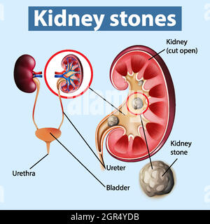 Informative Illustration von Nierensteinen Stock Vektor
