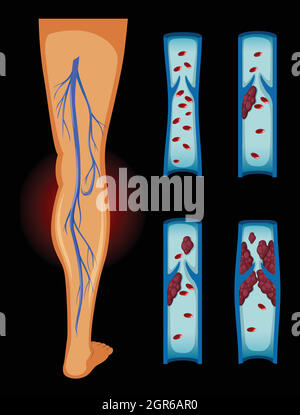 Blutgerinnsel im menschlichen Bein Stock Vektor