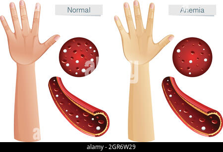 Menschliche Anatomie Vektor der Anämie Stock Vektor