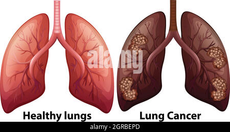 Menschliche Anatomie des Lungenzustandes Stock Vektor