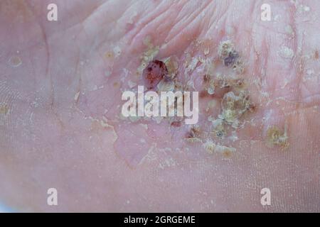 Schwere pustuläre Psoriasis-Läsionen an der Fußsohle Stockfoto