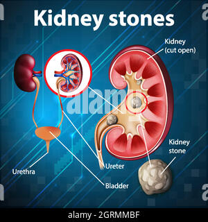 Informative Illustration von Nierensteinen Stock Vektor