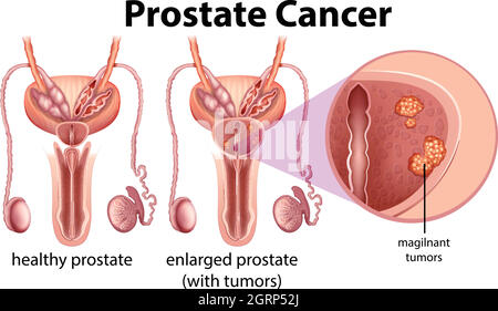Prostatakrebs auf weißem Hintergrund Stock Vektor