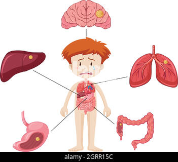 Boy und Diagramm zeigt verschiedene Teile von Organen mit Krankheit Stock Vektor