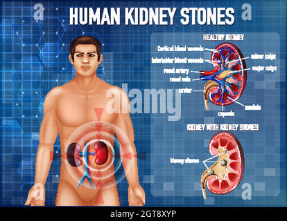 Informative Illustration von Nierensteinen Stock Vektor