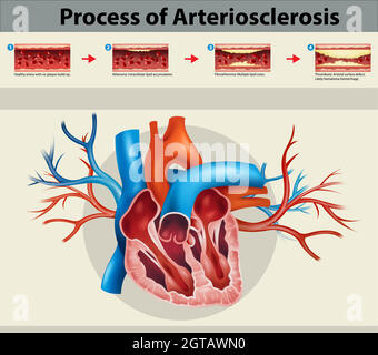 Plakat des Prozesses der Artriosklerose Stock Vektor