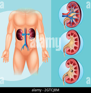 Menschen- und Nierensteine Stock Vektor