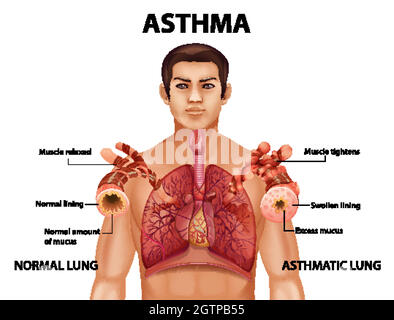 Vergleich von gesunder Lunge und asthmatischer Lunge Stock Vektor