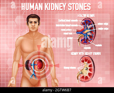 Informative Illustration von Nierensteinen Stock Vektor