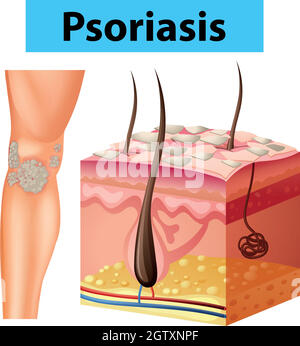 Diagramm mit Psoriasis auf der menschlichen Haut Stock Vektor