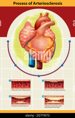 Poster des Arteriosklerose-Prozesses Stock Vektor