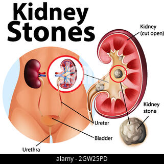 Informative Illustration von Nierensteinen Stock Vektor