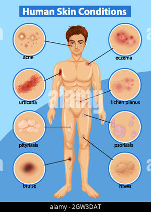 Diagramm mit unterschiedlichen menschlichen Hauterkrankungen Stock Vektor