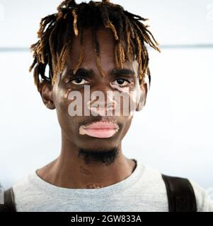 Afroamerikanischer schwarzer junger Mann mit Vitiligo-Haut Stockfoto