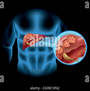 Leberkrebs Diagramm im Detail Stock Vektor