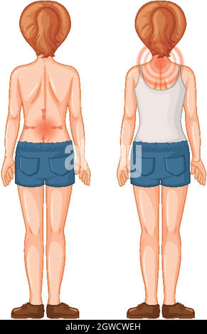 Rückseite der menschlichen Frau mit Schmerzpunkten Stock Vektor