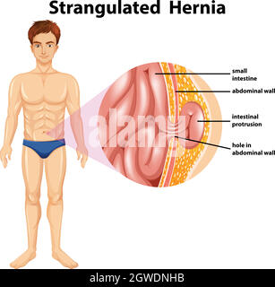 Menschliche Anatomie der Strangulierten Hernie Stock Vektor