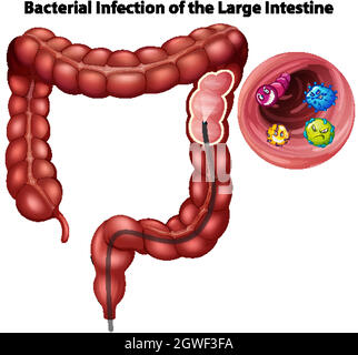 Bakterielle Infektion des Dickdarms Stock Vektor