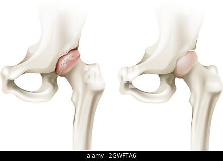 Hüftarthritis Stock Vektor