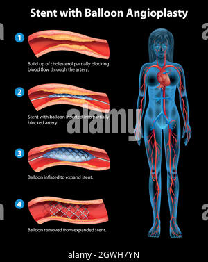 Verfahren der Angioplastie mit einem Gipsstaber Stock Vektor