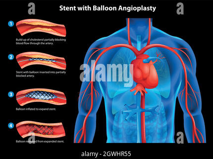 Mit Ballon-Angioplastie Stock Vektor