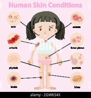 Diagramm mit den menschlichen Hauterkrankungen Stock Vektor