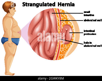 Man Strangulierte Hernie Diagramm Stock Vektor