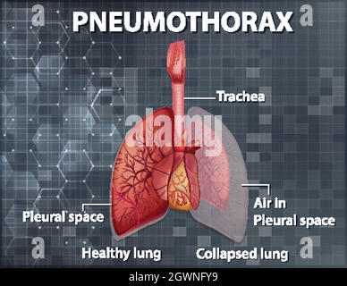 Informative Illustration des Pneumothorax Stock Vektor