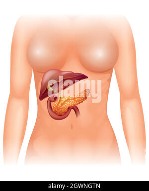 Bauchspeicheldrüsenkrebs beim Menschen Stock Vektor