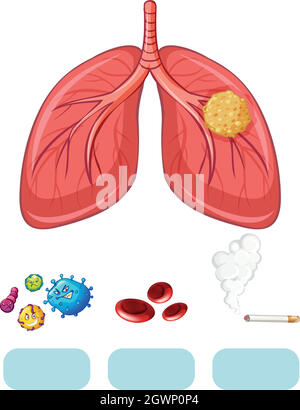 Lungenkrebsdiagramm mit Virus und Zigarette Stock Vektor
