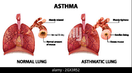 Vergleich von gesunder Lunge und asthmatischer Lunge Stock Vektor