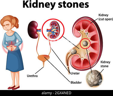 Informative Illustration von Nierensteinen Stock Vektor