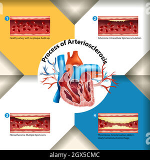 Prozess der Arteriosklerose Poster Stock Vektor