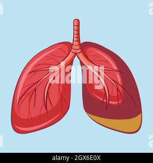 Menschliche Lunge mit Pleuramesotheliom Stock Vektor