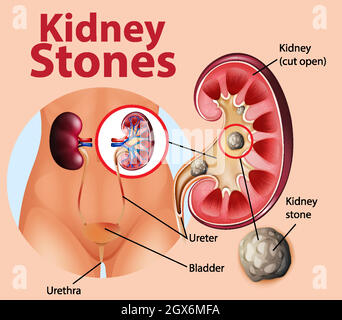 Informative Illustration von Nierensteinen Stock Vektor