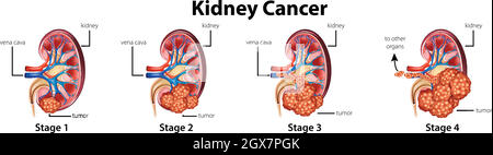 Diagramm mit verschiedenen Stadien von Nierenkrebs Stock Vektor